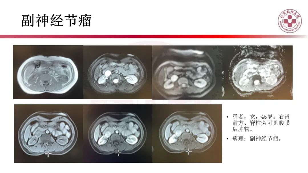 影像PPT - 【PPT】腹膜后囊性肿物-41