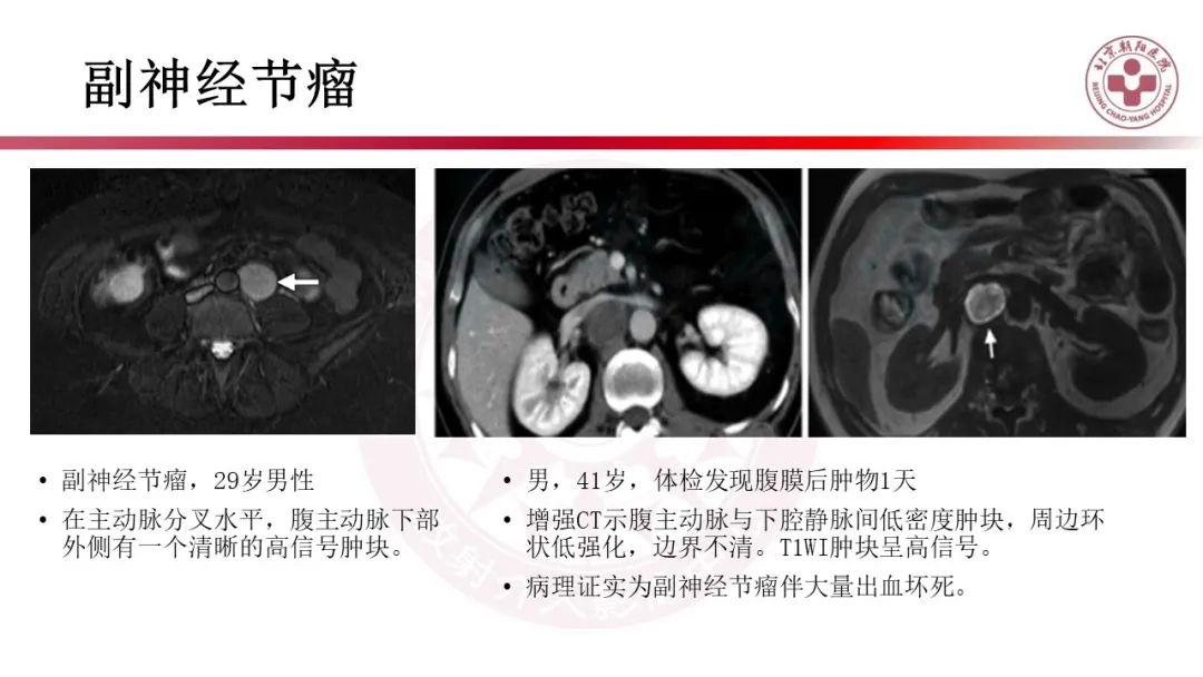 影像PPT - 【PPT】腹膜后囊性肿物-42