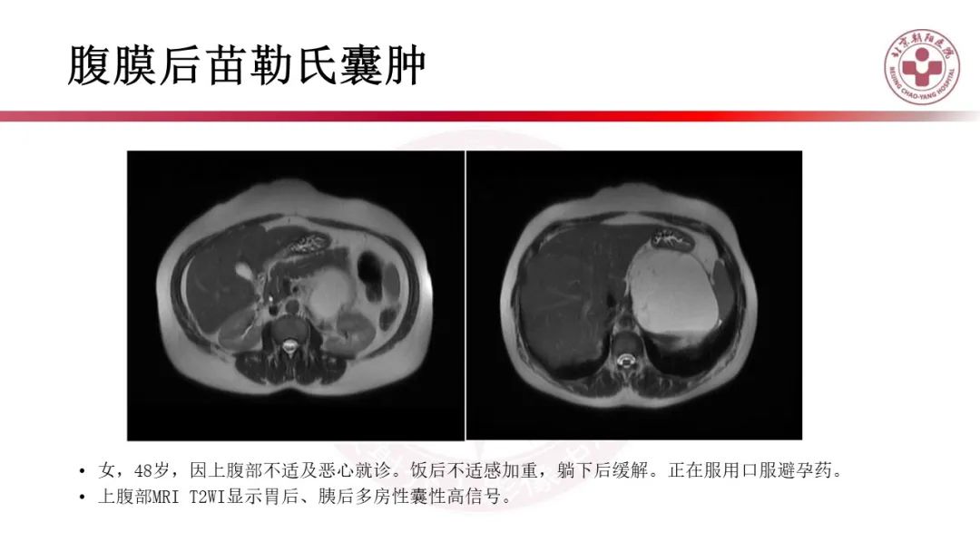 影像PPT - 【PPT】腹膜后囊性肿物-44