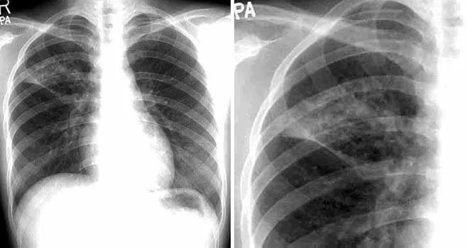 影像PPT - 囊腔型肺腺癌-5 影像PPT - 囊腔型肺腺癌-5