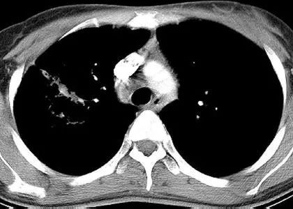 影像PPT - 囊腔型肺腺癌-7 影像PPT - 囊腔型肺腺癌-7