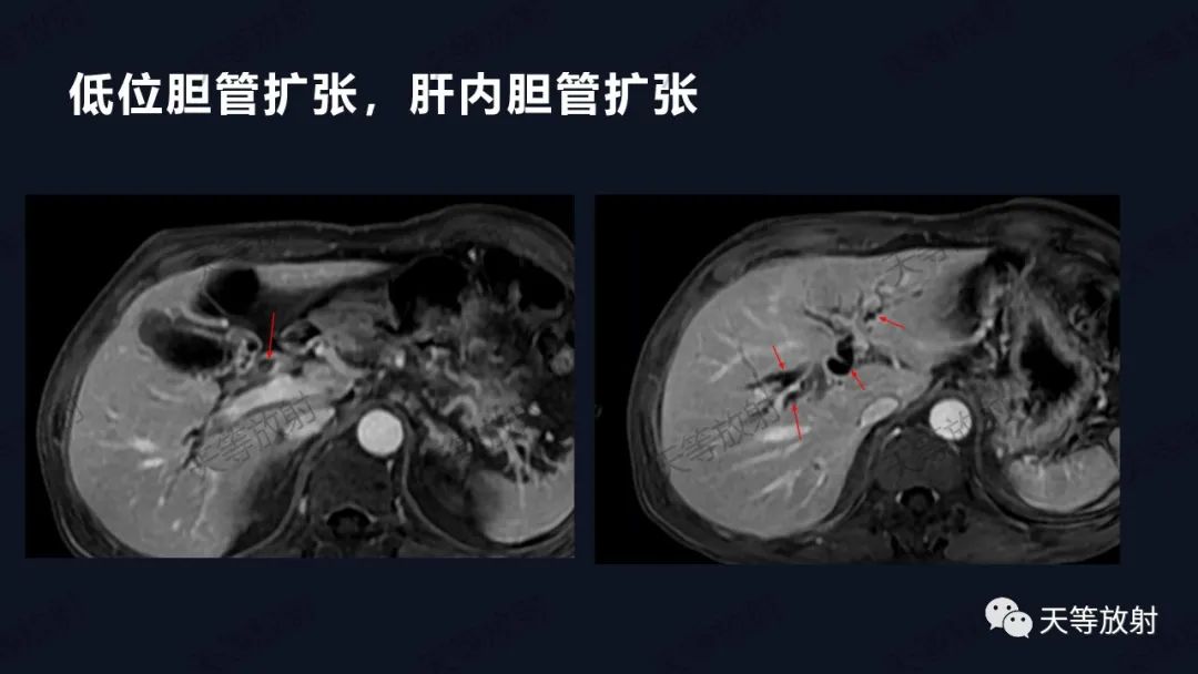 影像PPT - 【病例】IgG4相关性疾病1例CT及MR影像表现及文献复习-4 影像PPT - 【病例】IgG4相关性疾病1例CT及MR影像表现及文献复习-4