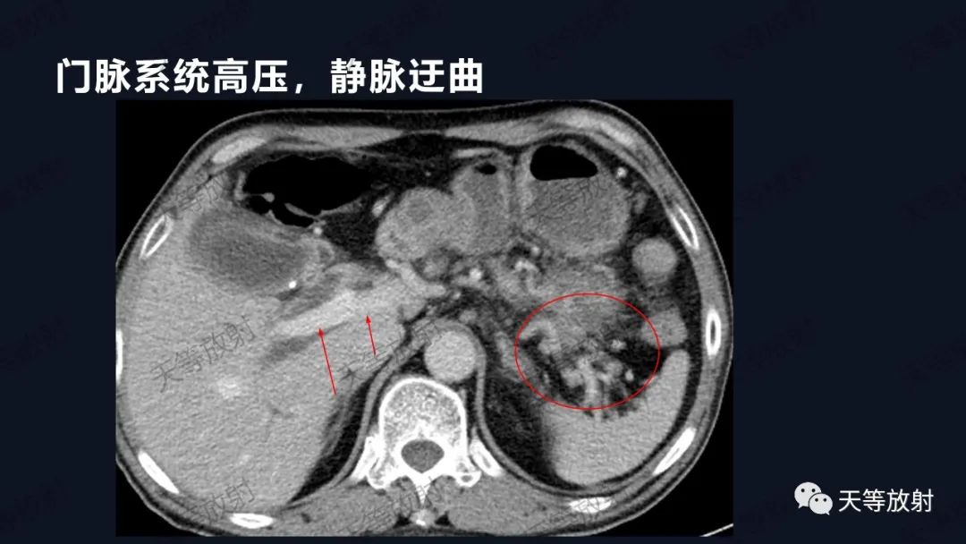 影像PPT - 【病例】IgG4相关性疾病1例CT及MR影像表现及文献复习-5 影像PPT - 【病例】IgG4相关性疾病1例CT及MR影像表现及文献复习-5