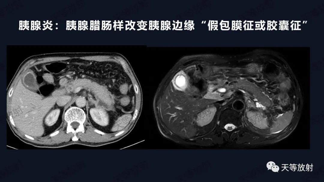 影像PPT - 【病例】IgG4相关性疾病1例CT及MR影像表现及文献复习-6 影像PPT - 【病例】IgG4相关性疾病1例CT及MR影像表现及文献复习-6