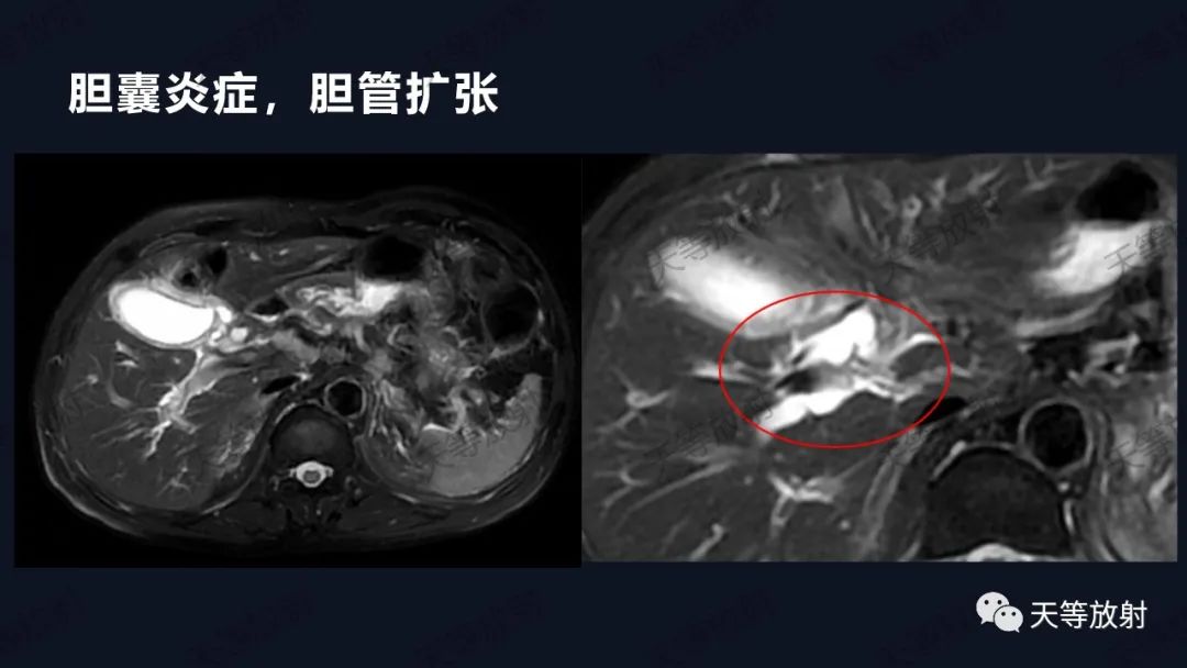 影像PPT - 【病例】IgG4相关性疾病1例CT及MR影像表现及文献复习-3 影像PPT - 【病例】IgG4相关性疾病1例CT及MR影像表现及文献复习-3