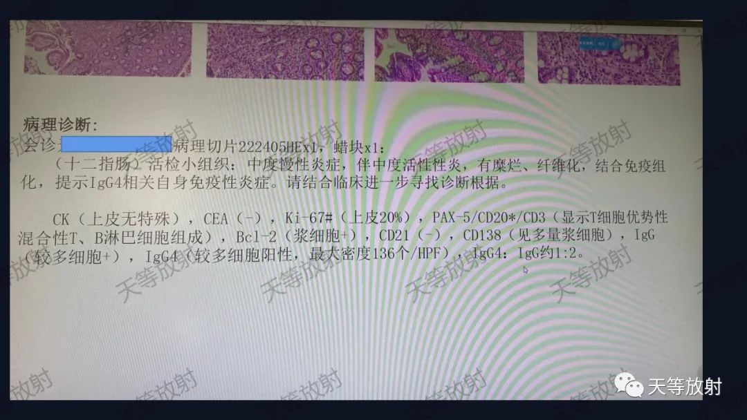 影像PPT - 【病例】IgG4相关性疾病1例CT及MR影像表现及文献复习-28 影像PPT - 【病例】IgG4相关性疾病1例CT及MR影像表现及文献复习-28