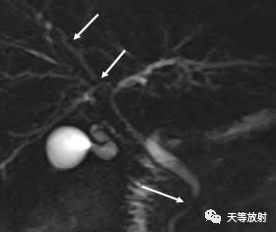 影像PPT - 【病例】IgG4相关性疾病1例CT及MR影像表现及文献复习-41 影像PPT - 【病例】IgG4相关性疾病1例CT及MR影像表现及文献复习-41