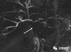 影像PPT - 【病例】IgG4相关性疾病1例CT及MR影像表现及文献复习-43 影像PPT - 【病例】IgG4相关性疾病1例CT及MR影像表现及文献复习-43