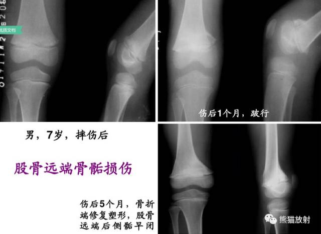 影像PPT - 骨骺损伤的分型及影像表现-22 影像PPT - 骨骺损伤的分型及影像表现-22