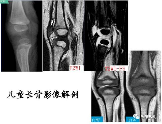 影像PPT - 骨骺损伤的分型及影像表现-23 影像PPT - 骨骺损伤的分型及影像表现-23