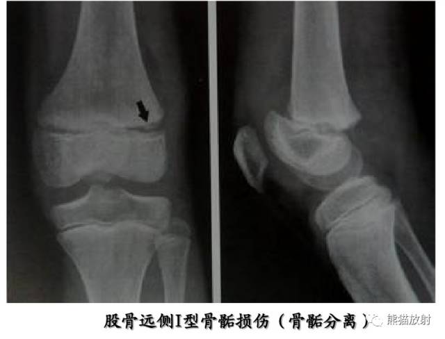 影像PPT - 骨骺损伤的分型及影像表现-25 影像PPT - 骨骺损伤的分型及影像表现-25