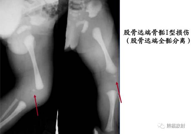 影像PPT - 骨骺损伤的分型及影像表现-24 影像PPT - 骨骺损伤的分型及影像表现-24