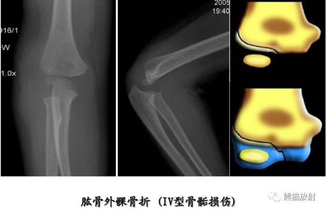 影像PPT - 骨骺损伤的分型及影像表现-31 影像PPT - 骨骺损伤的分型及影像表现-31