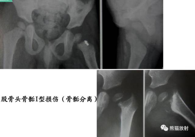 影像PPT - 骨骺损伤的分型及影像表现-26 影像PPT - 骨骺损伤的分型及影像表现-26