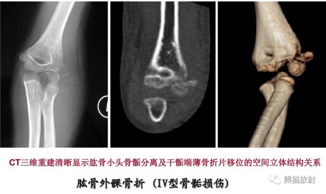 影像PPT - 骨骺损伤的分型及影像表现-32 影像PPT - 骨骺损伤的分型及影像表现-32
