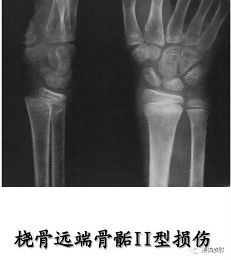 影像PPT - 骨骺损伤的分型及影像表现-28 影像PPT - 骨骺损伤的分型及影像表现-28