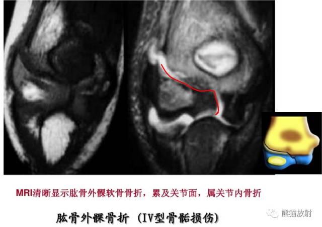 影像PPT - 骨骺损伤的分型及影像表现-33 影像PPT - 骨骺损伤的分型及影像表现-33