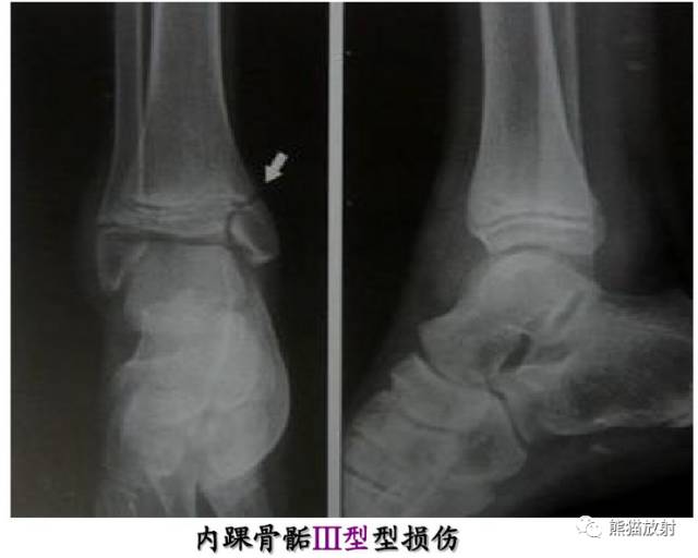 影像PPT - 骨骺损伤的分型及影像表现-29 影像PPT - 骨骺损伤的分型及影像表现-29