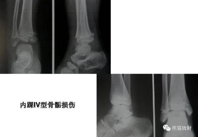 影像PPT - 骨骺损伤的分型及影像表现-35 影像PPT - 骨骺损伤的分型及影像表现-35