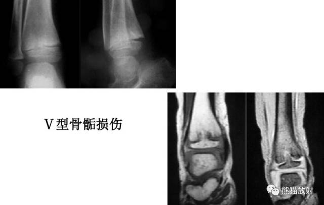 影像PPT - 骨骺损伤的分型及影像表现-37 影像PPT - 骨骺损伤的分型及影像表现-37