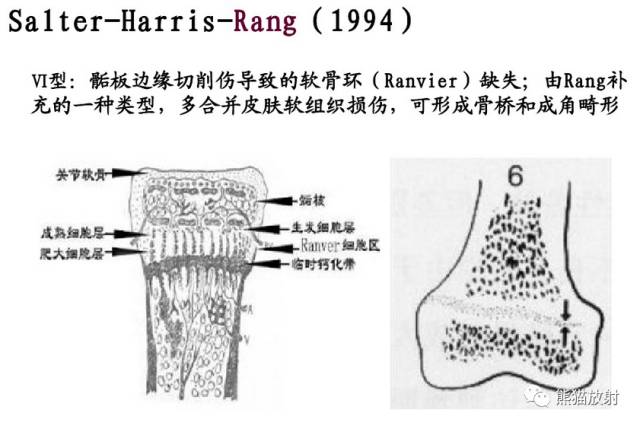 影像PPT - 骨骺损伤的分型及影像表现-38 影像PPT - 骨骺损伤的分型及影像表现-38