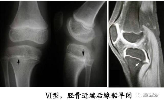 影像PPT - 骨骺损伤的分型及影像表现-39 影像PPT - 骨骺损伤的分型及影像表现-39