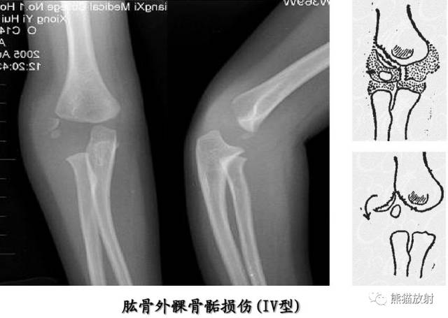影像PPT - 骨骺损伤的分型及影像表现-34 影像PPT - 骨骺损伤的分型及影像表现-34