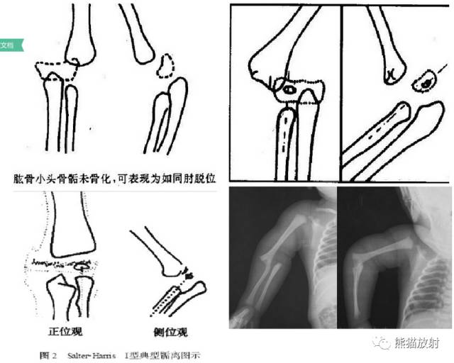 影像PPT - 骨骺损伤的分型及影像表现-43 影像PPT - 骨骺损伤的分型及影像表现-43