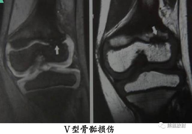 影像PPT - 骨骺损伤的分型及影像表现-36 影像PPT - 骨骺损伤的分型及影像表现-36