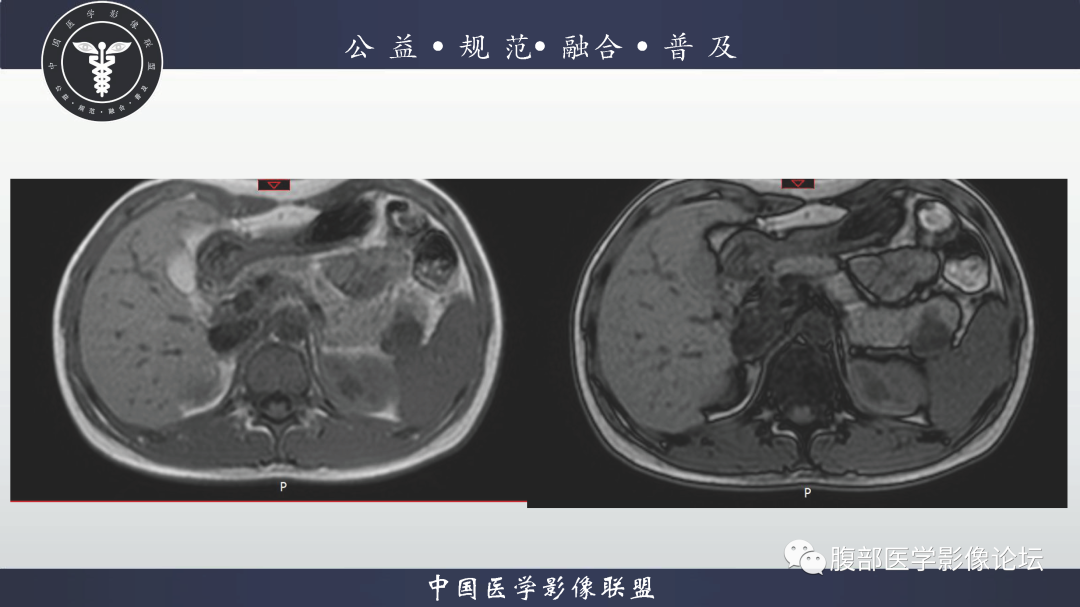 影像PPT - 【病例】胰腺淋巴上皮囊肿1例影像诊断-3
