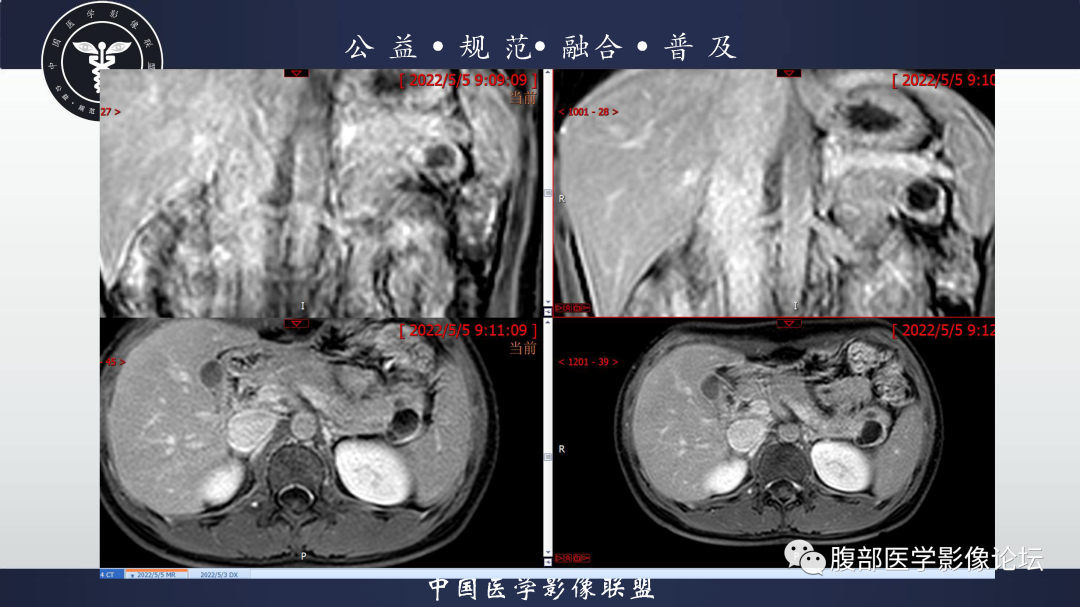 影像PPT - 【病例】胰腺淋巴上皮囊肿1例影像诊断-5