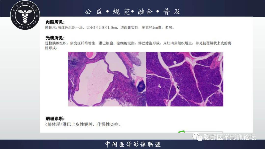 影像PPT - 【病例】胰腺淋巴上皮囊肿1例影像诊断-6