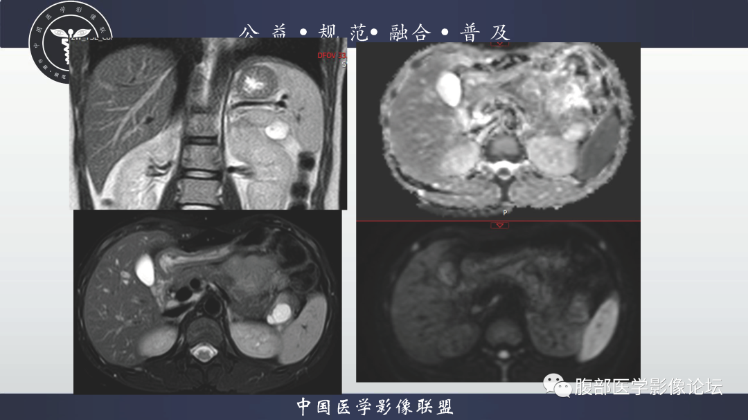 影像PPT - 【病例】胰腺淋巴上皮囊肿1例影像诊断-2