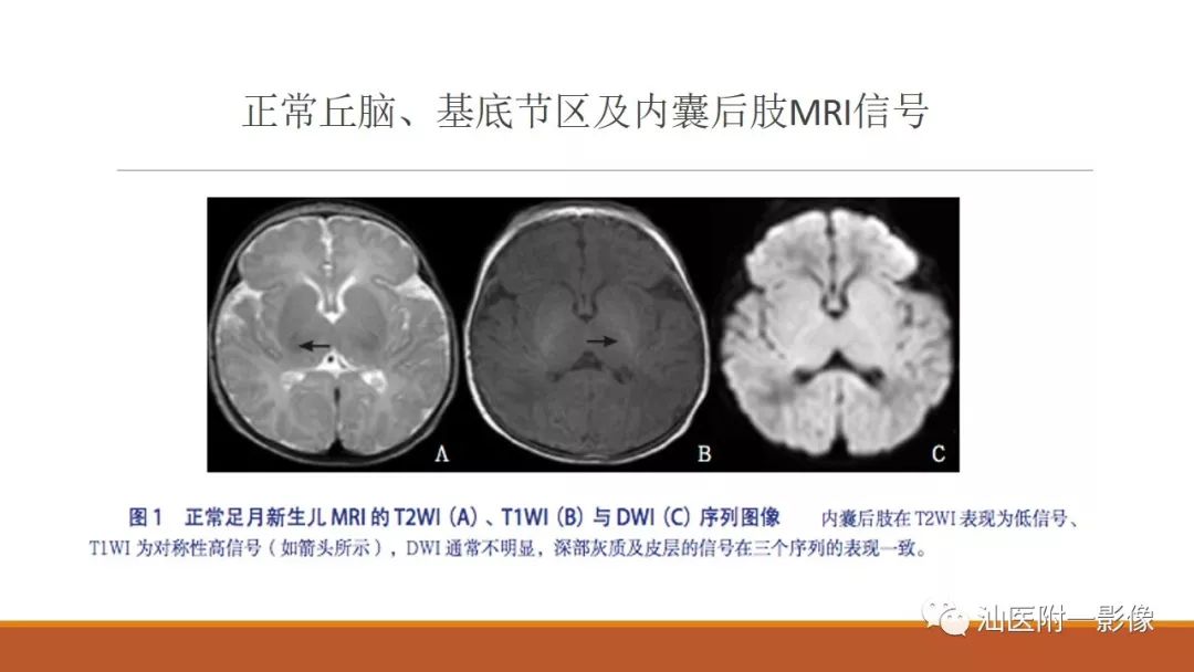 影像PPT - 【PPT】新生儿缺氧缺血性脑病磁共振诊断与损伤类型的分类建议-9