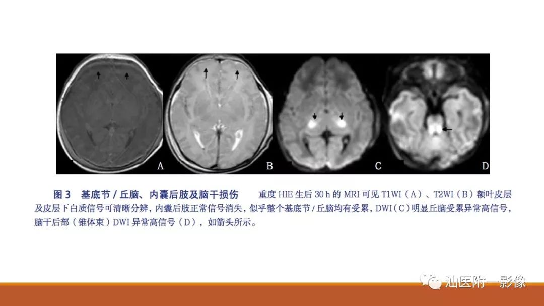 影像PPT - 【PPT】新生儿缺氧缺血性脑病磁共振诊断与损伤类型的分类建议-11