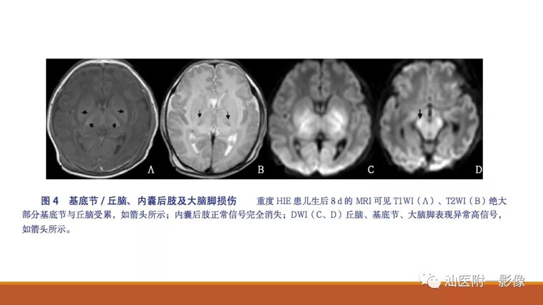 影像PPT - 【PPT】新生儿缺氧缺血性脑病磁共振诊断与损伤类型的分类建议-12