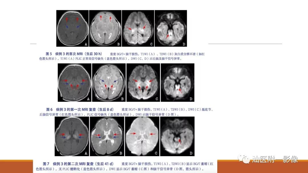 影像PPT - 【PPT】新生儿缺氧缺血性脑病磁共振诊断与损伤类型的分类建议-19