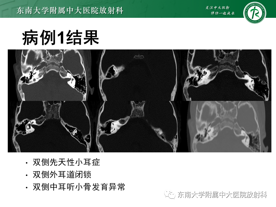 影像PPT - 【PPT】先天性耳发育畸形-2