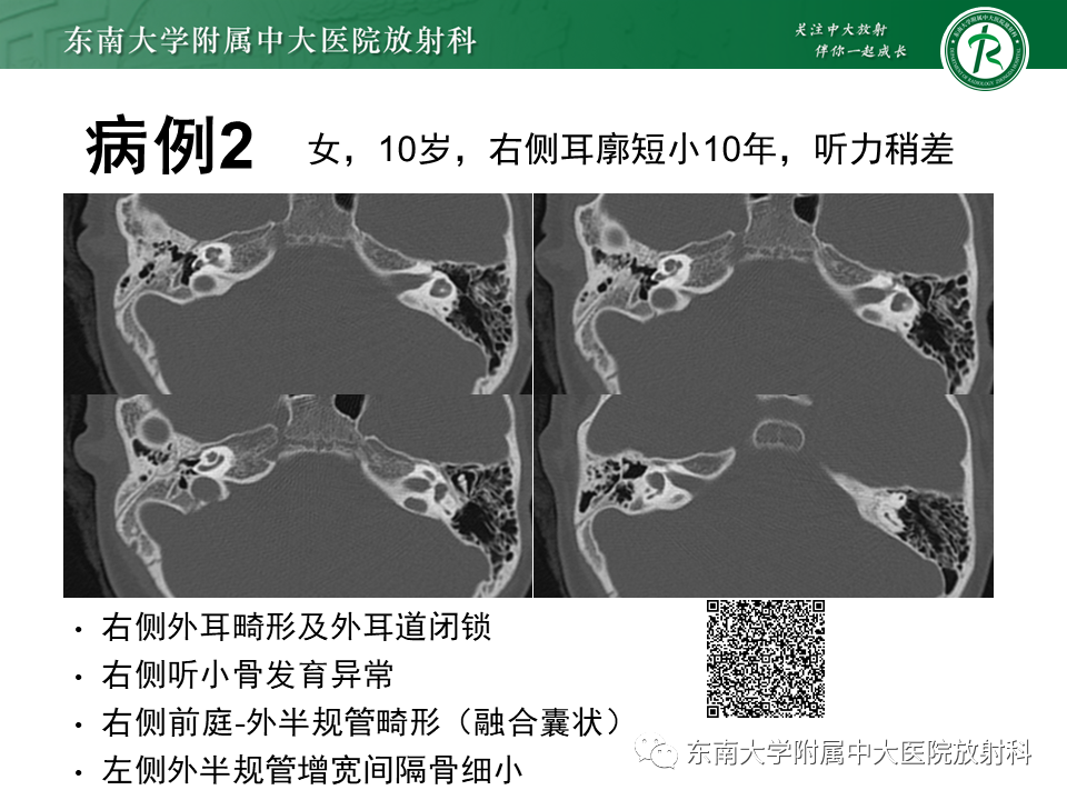 影像PPT - 【PPT】先天性耳发育畸形-3