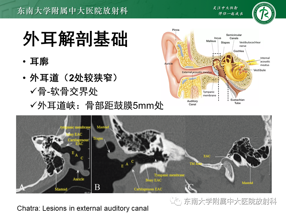 影像PPT - 【PPT】先天性耳发育畸形-7