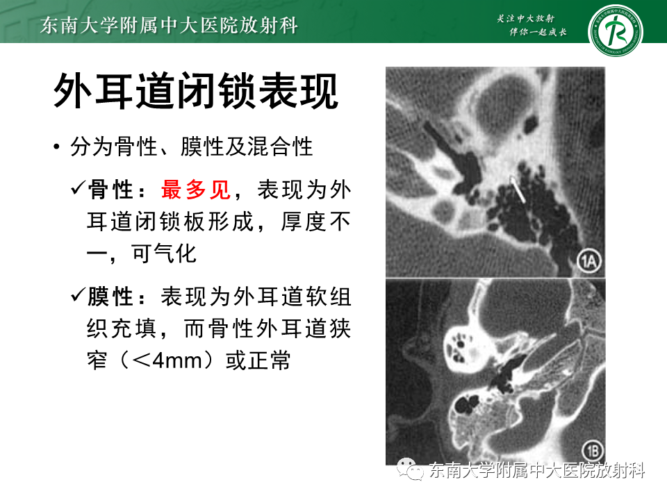 影像PPT - 【PPT】先天性耳发育畸形-19