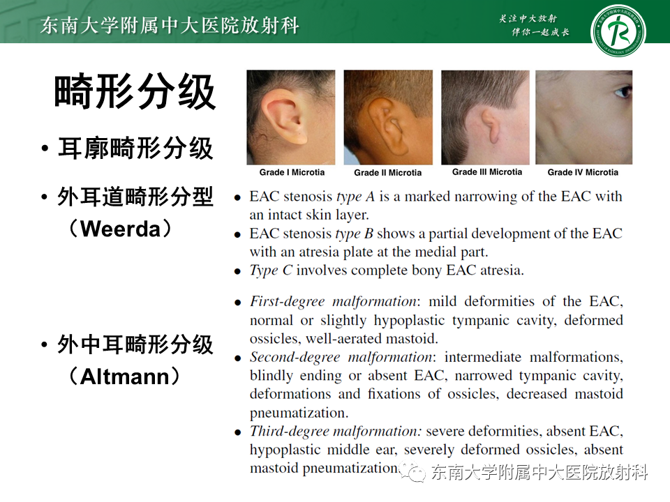 影像PPT - 【PPT】先天性耳发育畸形-20