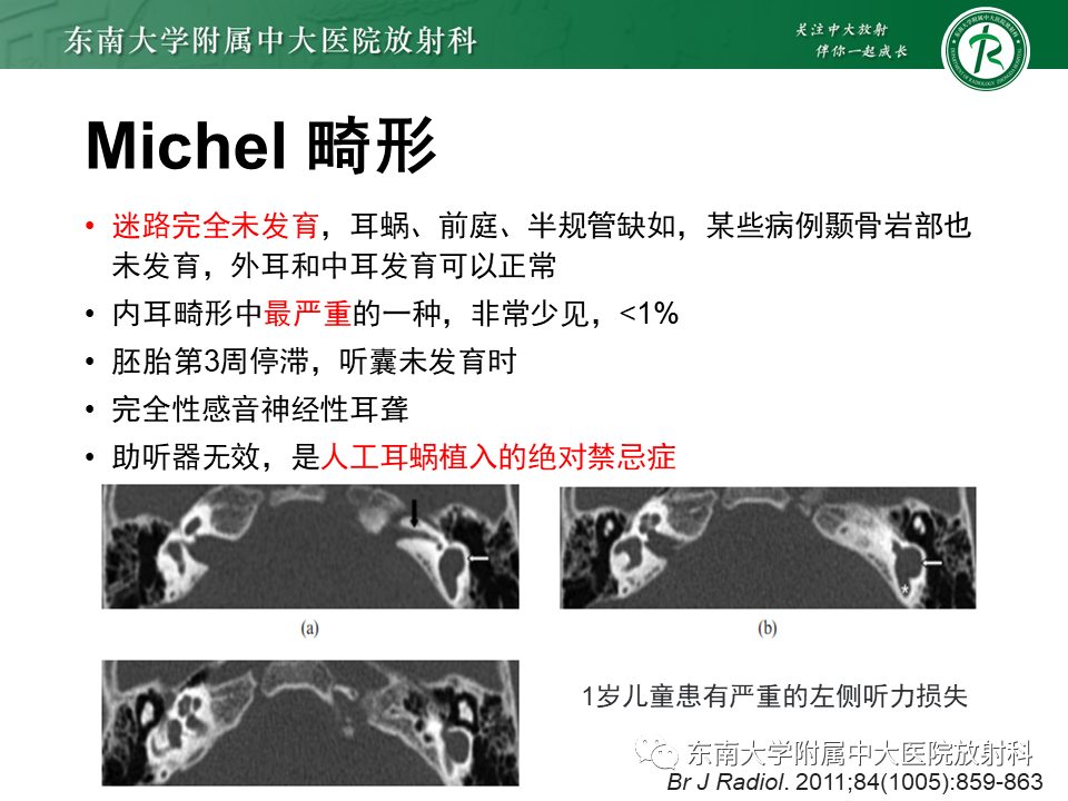 影像PPT - 【PPT】先天性耳发育畸形-25