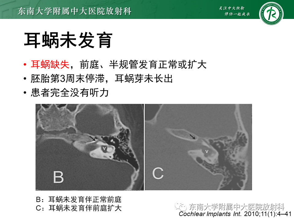 影像PPT - 【PPT】先天性耳发育畸形-26