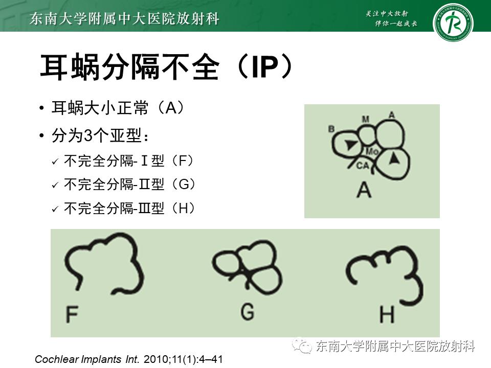 影像PPT - 【PPT】先天性耳发育畸形-27