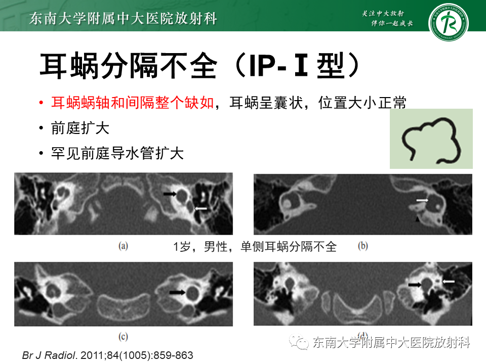 影像PPT - 【PPT】先天性耳发育畸形-28