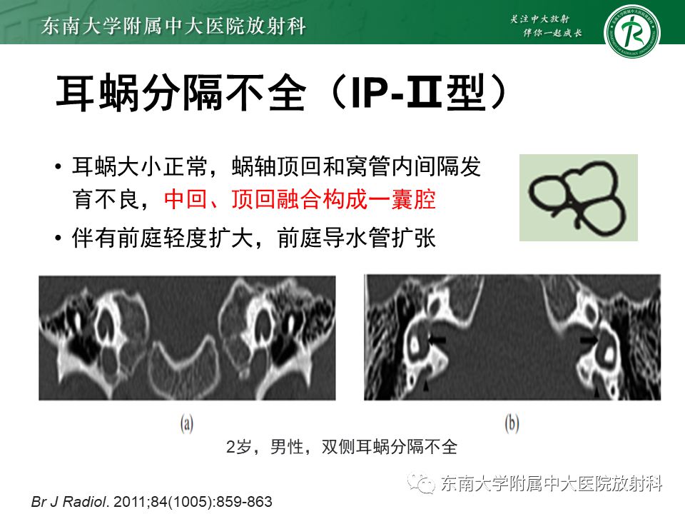 影像PPT - 【PPT】先天性耳发育畸形-29