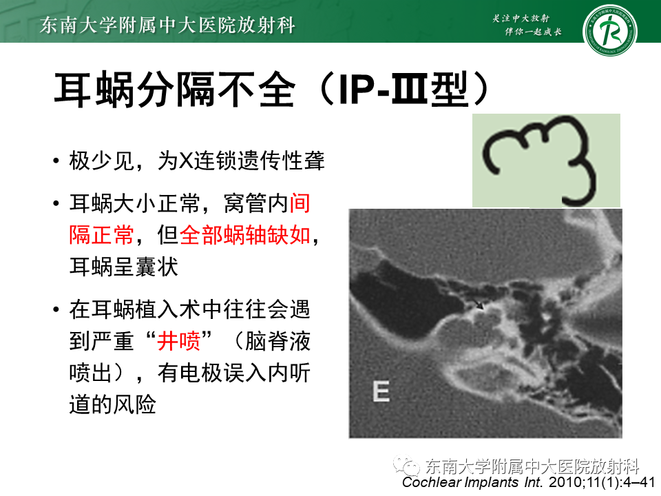 影像PPT - 【PPT】先天性耳发育畸形-30