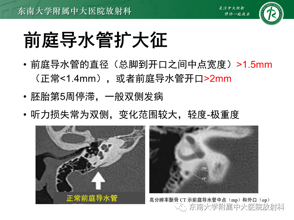 影像PPT - 【PPT】先天性耳发育畸形-34