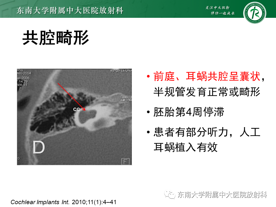影像PPT - 【PPT】先天性耳发育畸形-32